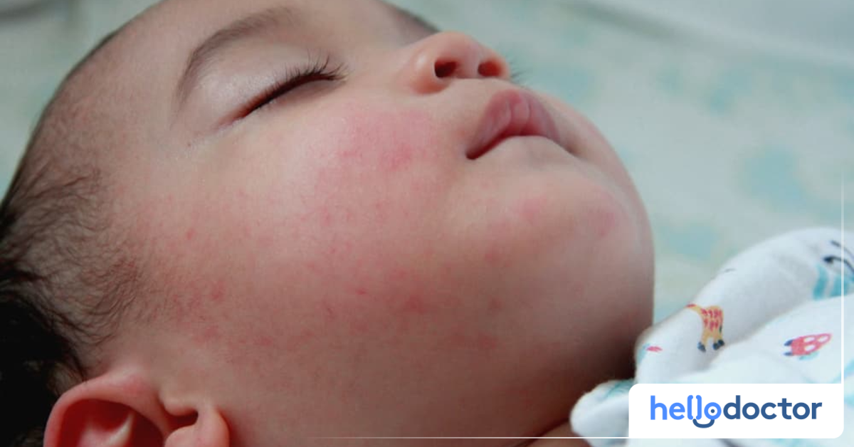 How To Treat Hives While Breastfeeding?