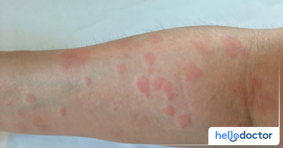 Systemic Lupus Erythematosus (SLE): What You Need to Know