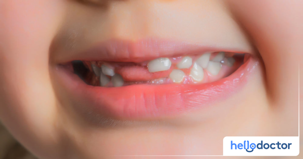 When Do Milk Teeth Fall Out in Children? Learn More Here