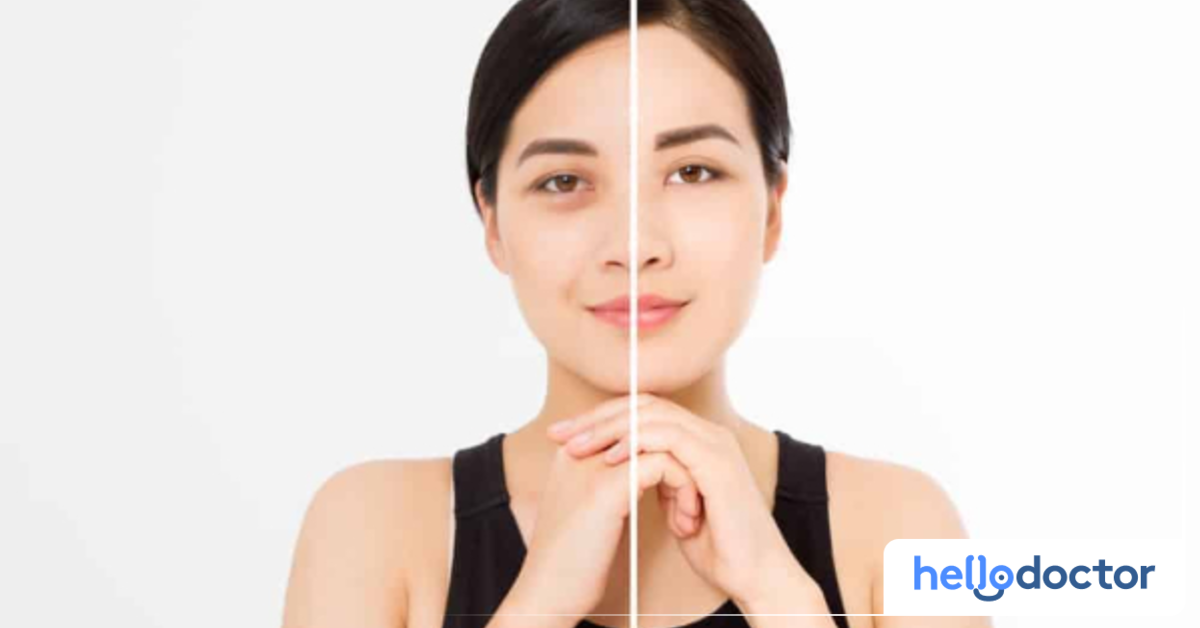 Eye Bag Removal Home Remedies and Cosmetic Procedures