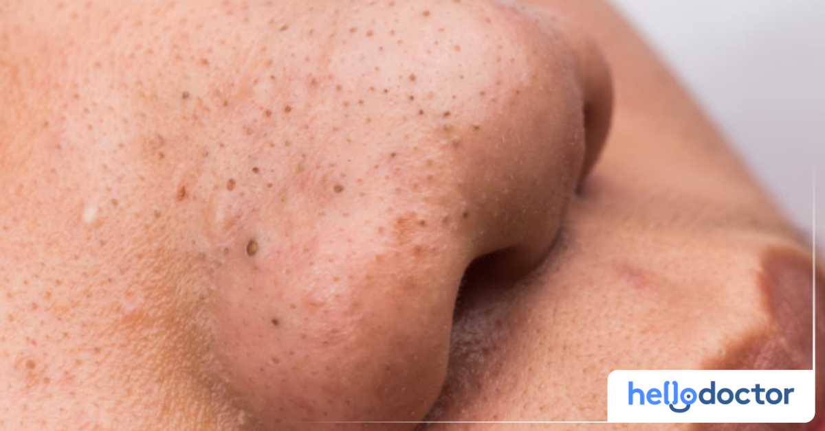 Salicylic Acid For Blackheads Is It Effective? Find Out Here